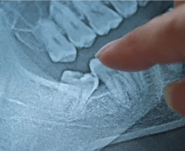 Wisdom Teeth Removal Specialist at Robert Lawrence Wilson, DDS, P.A. in Heber Springs, Arkansas